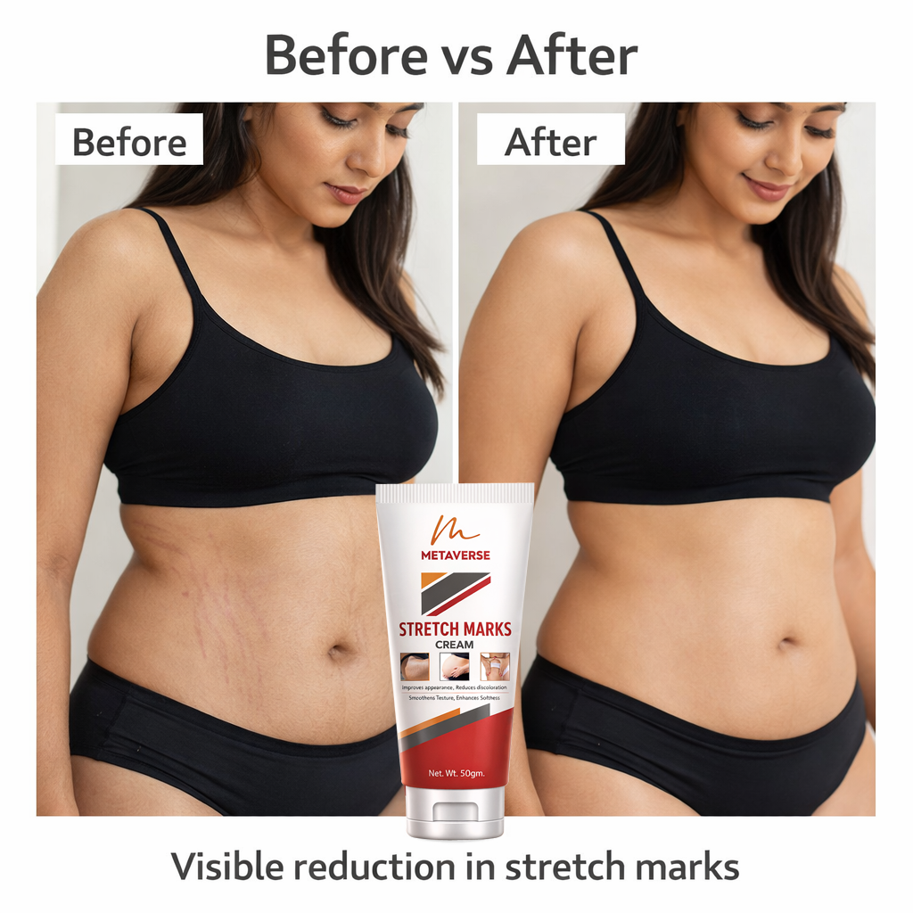 Metaverse Stretch Marks Cream for Women & Men – Skin Repair, Hydration & Smoothing Formula for Pregnancy & Weight Loss Marks